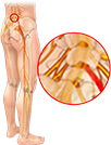 Illustration of sciatic nerve pain