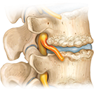 Illustration of an arthritic spine