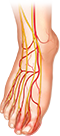 Illustration of DPN nerve pain