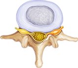 Radiculopathy